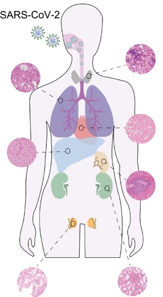 新冠病人多器官样本采集和镜下病理学检查.jpg