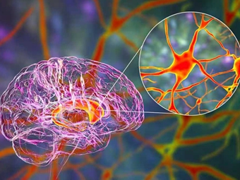 亨廷顿舞蹈症首次采用基因疗法治疗